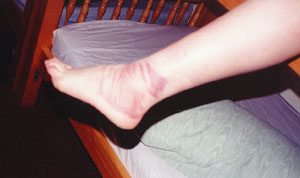 swollen ankle with bandage marks